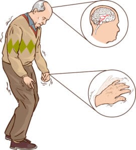 Parkinson Symptoms - TeleLeaf RX