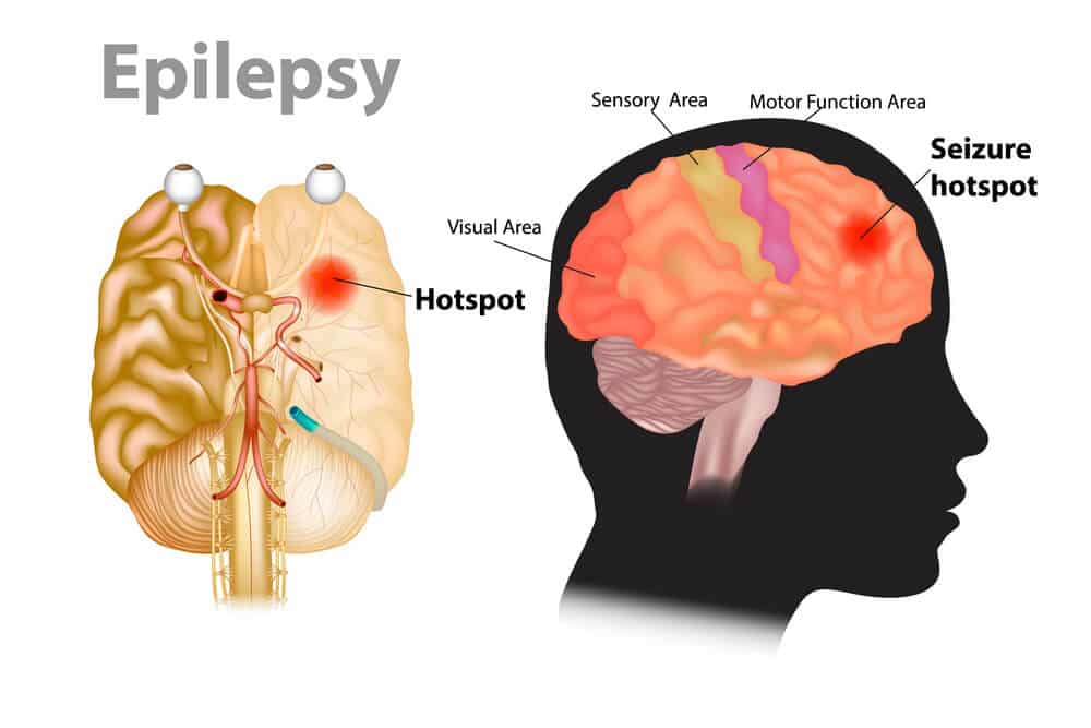epilepsy disease
