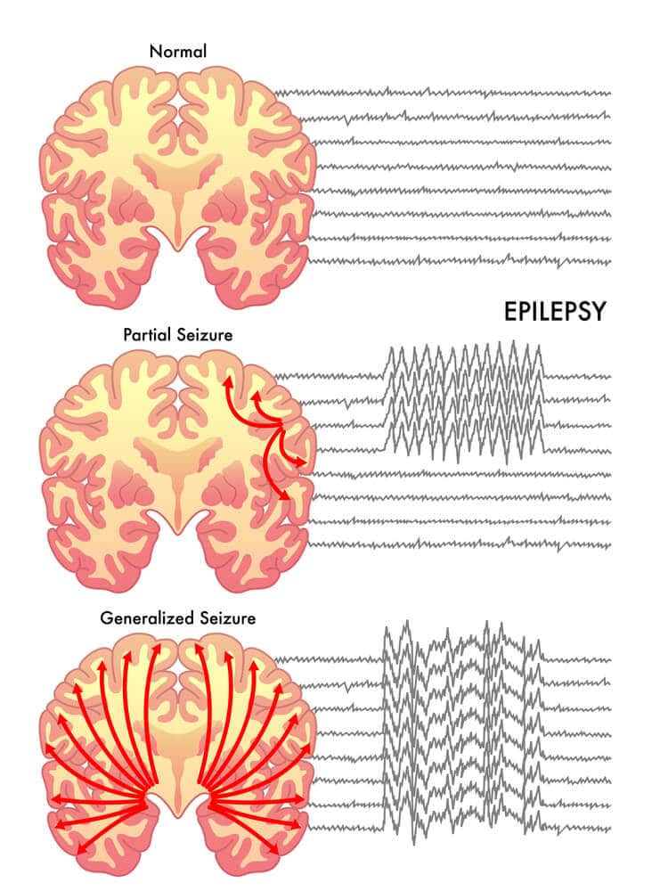 epileptic seizures