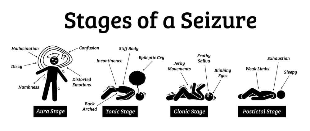 Stages and phases of a seizure - Tele Leaf RX