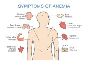 Symptoms common to many types of Anemia - Tele Leaf RX