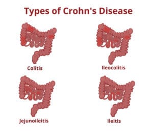 Types of Crohn's Disease-TeleLeaf RX
